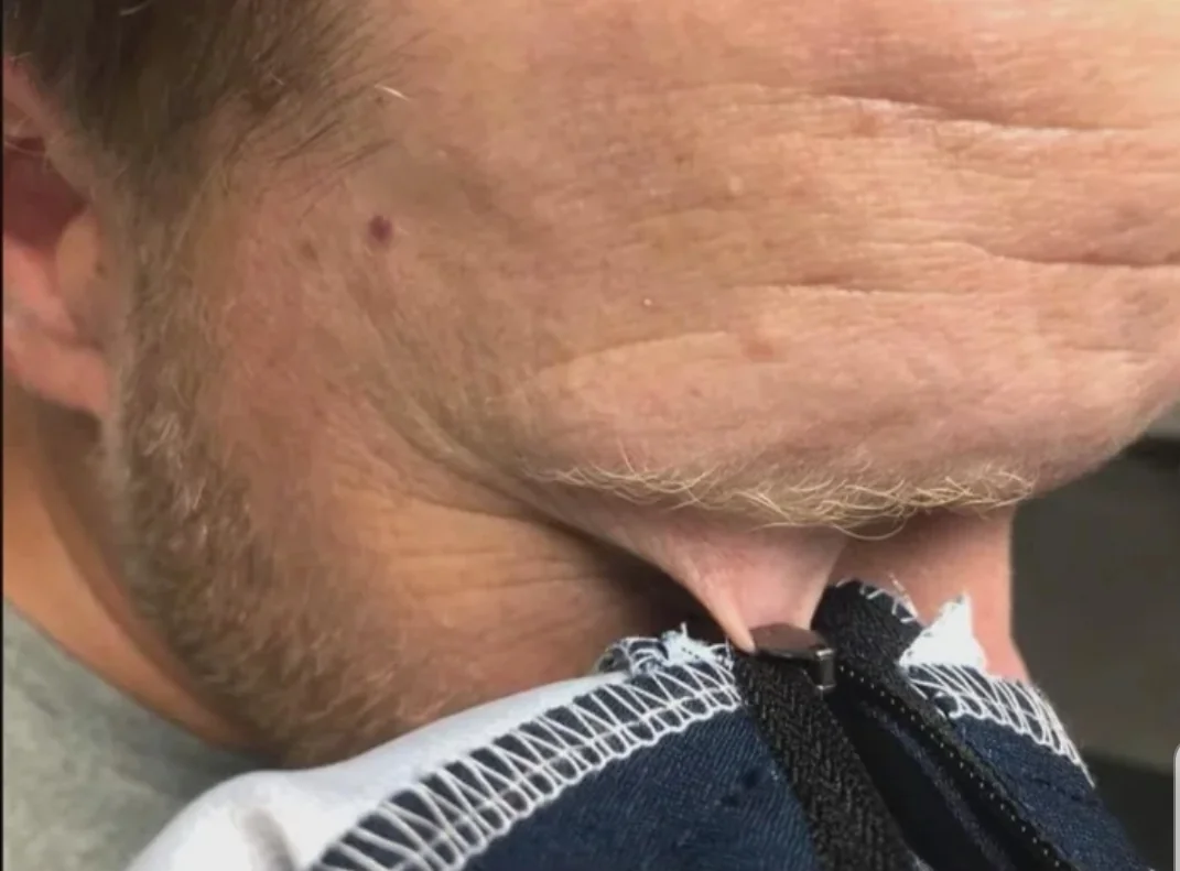 man caught his eyelid in a zipper